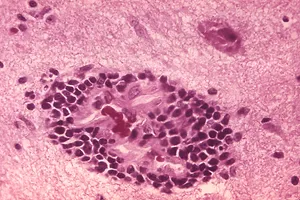 A pink-stained brain-tissue histology micrograph showing a dense oval cluster of purple-stained lymphocytes cuffing a blood vessel, a pattern associated with rabies encephalitis.